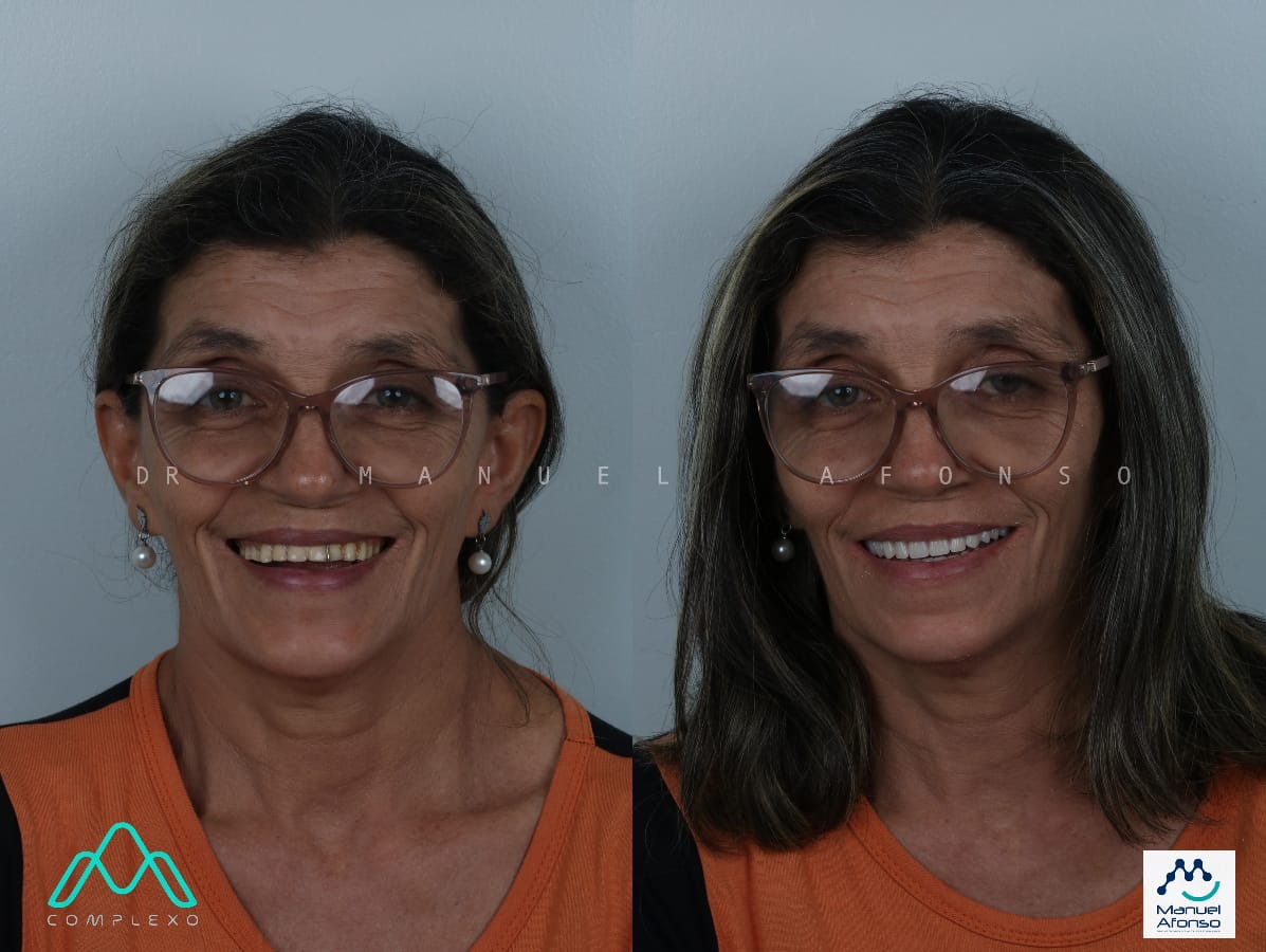 Caso clínico de prótese removível total — antes e depois