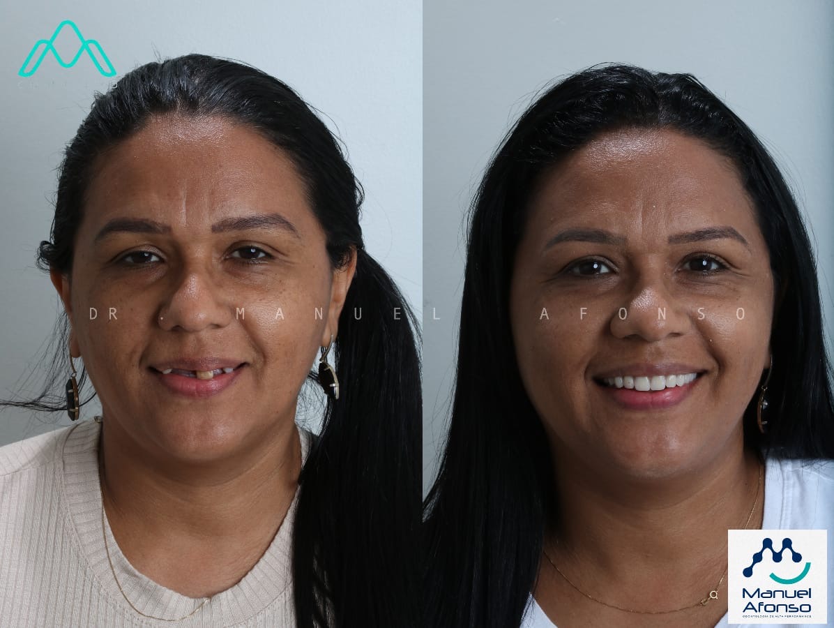 Caso clínico de prótese fixa sobre implantes — antes e depois