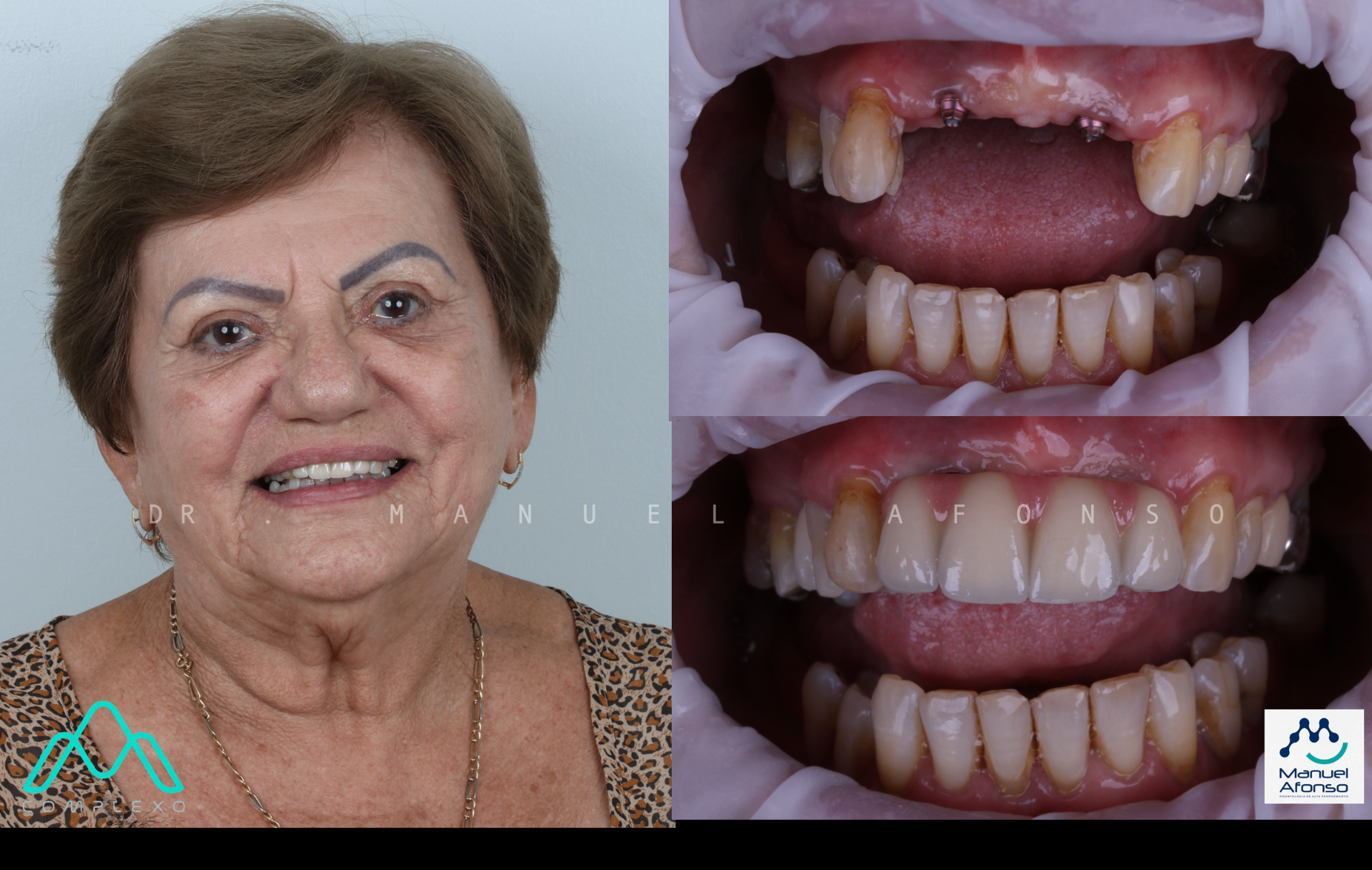 Caso clínico de implante duplo — antes e depois
